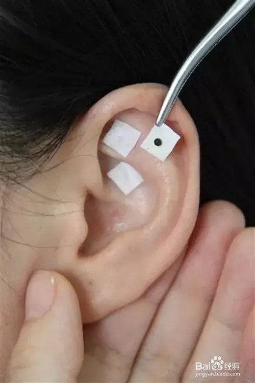 女生青春痘的治疗方法