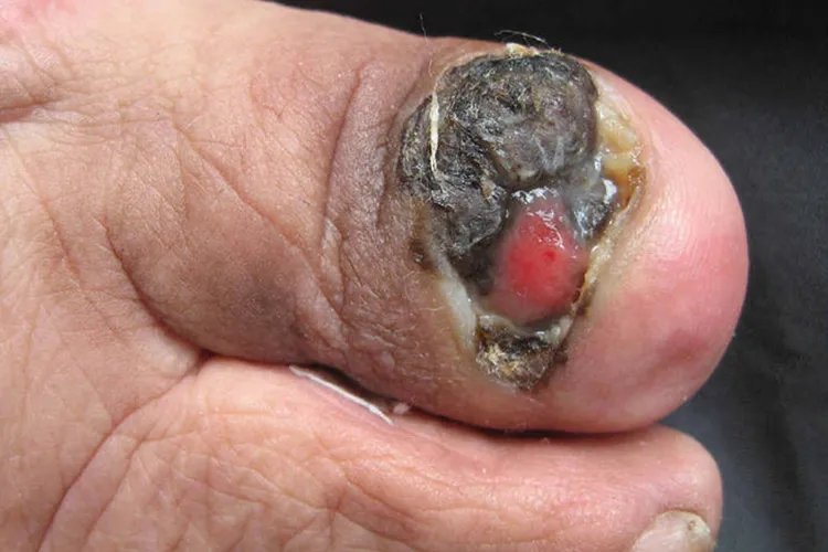 黑色素瘤一般长在什么部位