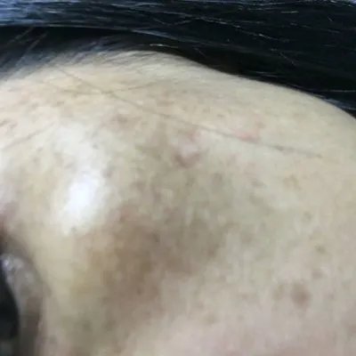 眼角有黄褐斑是什么原因?