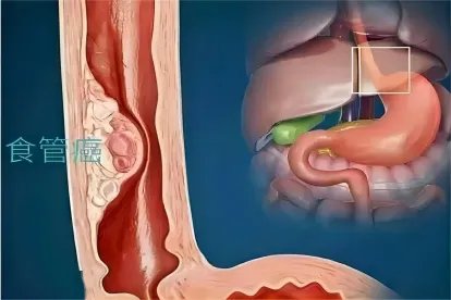 食道癌位置图片大全