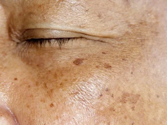 黄褐斑激光治疗