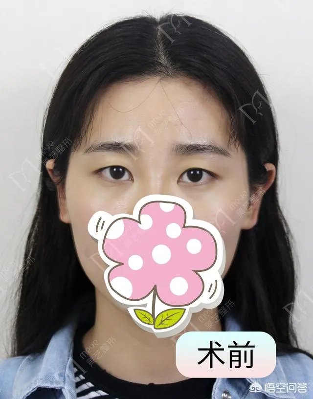 上睑下垂矫正术一定要做双眼皮吗