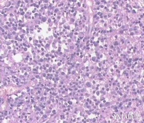 左背部酸痛的原因有哪些5个疾病会引起后背疼