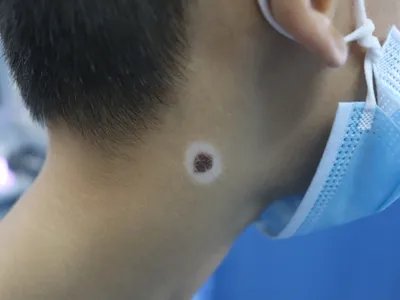 未定类型白癜风颈部白斑图片