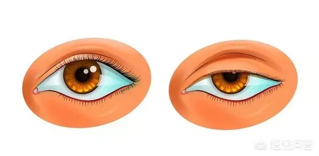 上睑下垂矫正术一定要做双眼皮吗