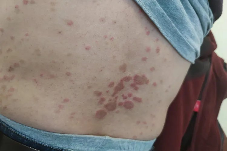 脂溢性皮炎的症状图片