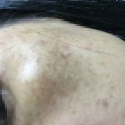 眼角有黄褐斑是什么原因?