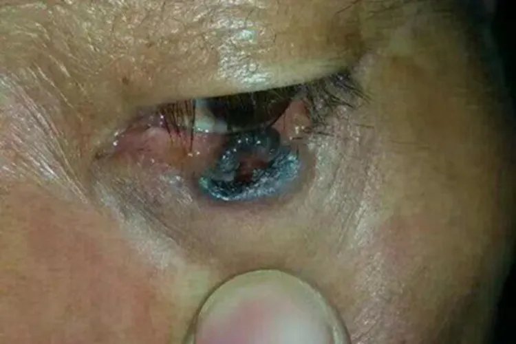 恶性黑色素瘤眼周大疙瘩图片