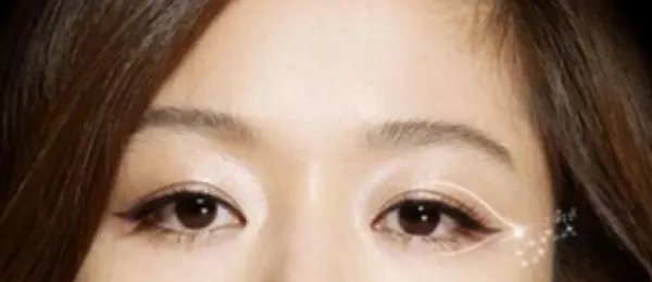 开眼角割双眼皮多少钱