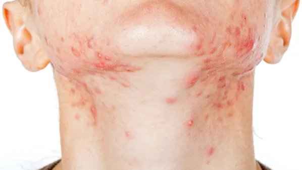 痤疮反复长怎么办