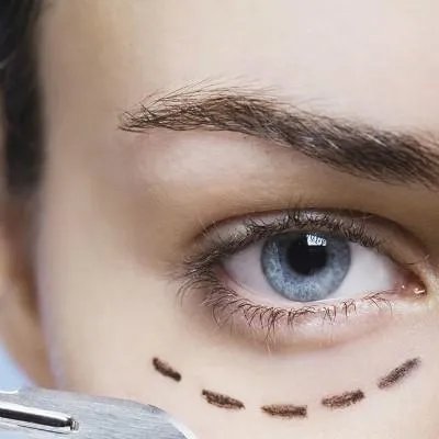 去眼袋简单方法有哪些