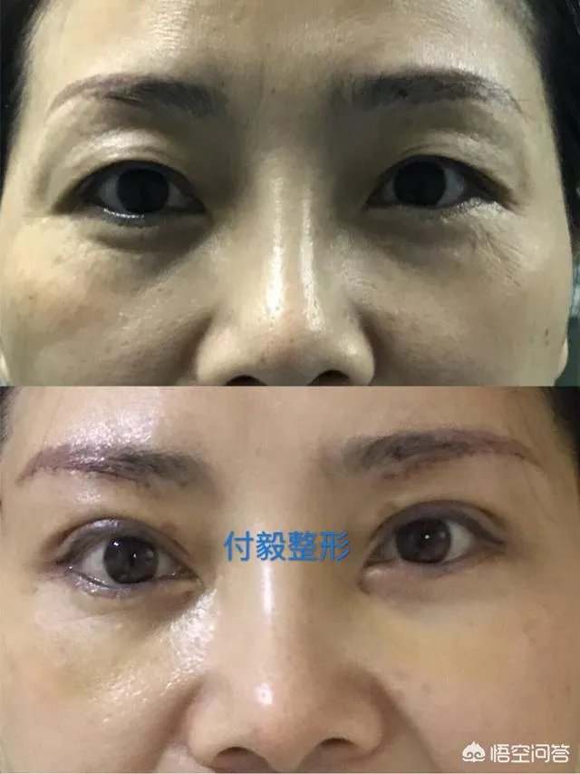 上睑下垂矫正术一定要做双眼皮吗