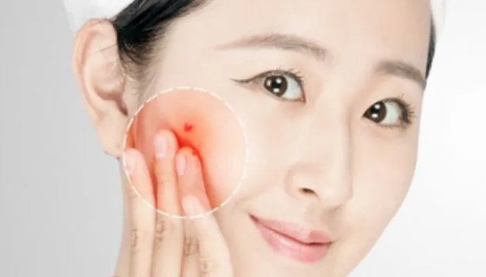 粉刺和痘痘的区别是什么 怎么区分痘痘和粉刺