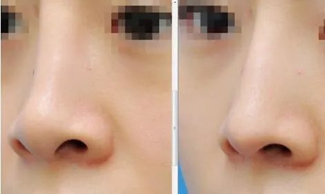 鼻头鼻翼缩小前后对比