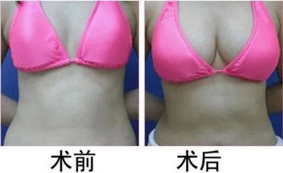 隆胸失败整容前后对比