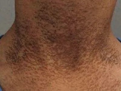 皮肤垢着病症状图片