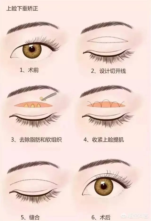 上睑下垂矫正术一定要做双眼皮吗